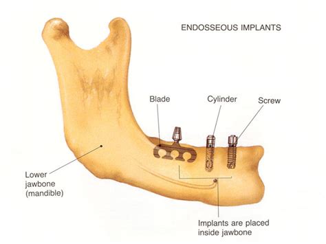 .::Dental Implant Center | Services| Types | Endosteal Impant::.