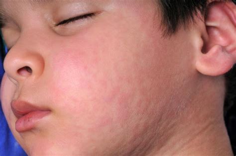 What Is Rubella?