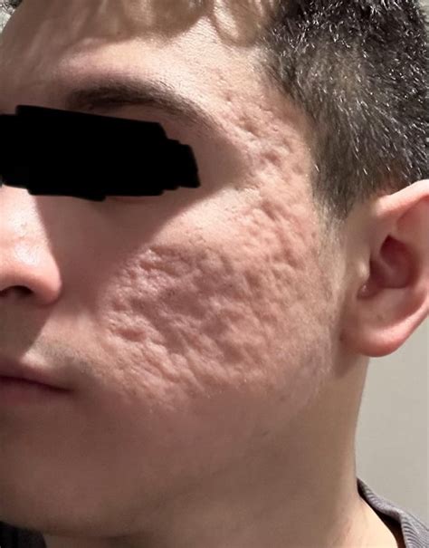 Deep acne scars : r/AcneScars
