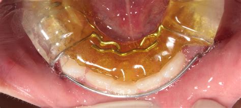 Зачем исправлять положение нижней челюсти? :: NORD DENTAL — сеть клиник ...