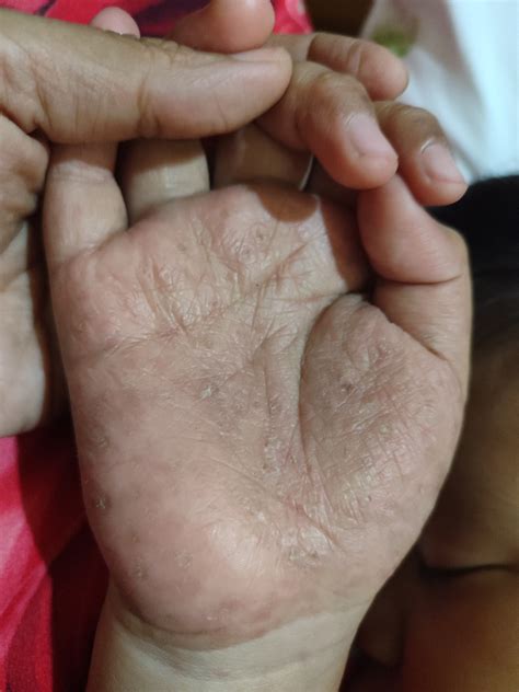 bintik berair  telapak tangan  kaki hellosehat