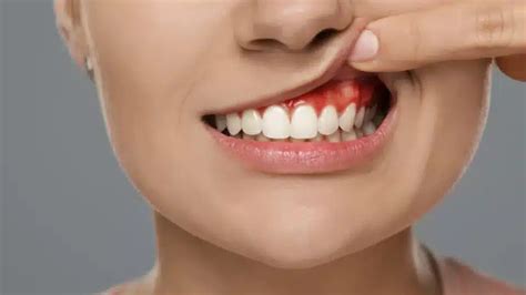 tooth abscess  symptoms treatment