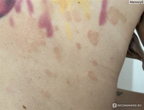 Шампунь противогрибковый Hemofarm Mycoseb - «Помог от грибка на коже ...