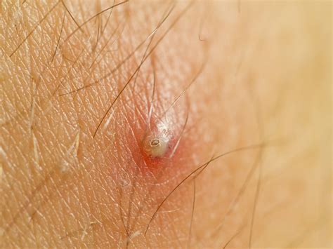 ingrown hair boil pictures - Miesha Short