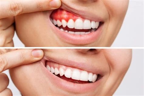 gingivitis  periodontitis doctor smiles orthodontics