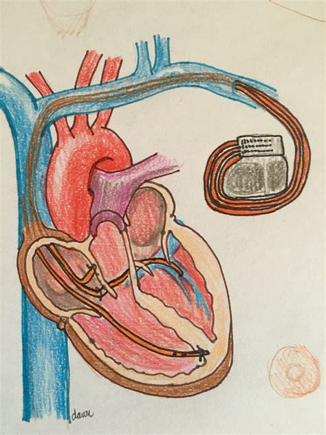 Cardiac resynchronization therapy | ECG Guru - Instructor Resources
