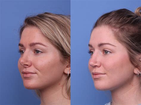 rhinoplasty       nose job  achieve hobgood