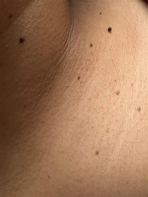 Skin tags- how to get rid of skin tags? : r/30PlusSkinCare