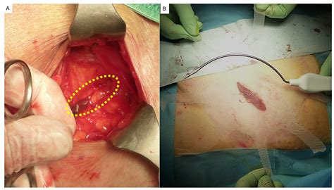 tentacle mesh  fixation  spigelian hernia repair mini invasive