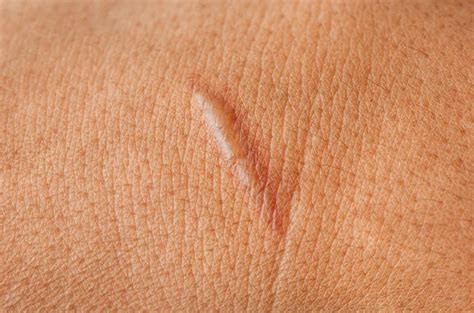 keloid gejala penyebab pencegahan pengobatan