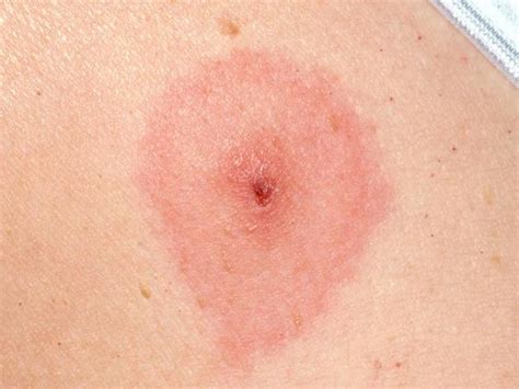 What Does A Tick Bite Rash Look Like | Images and Photos finder