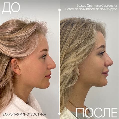 Ринопластика в Санкт-Петербурге - цены на пластику носа в Институте ...