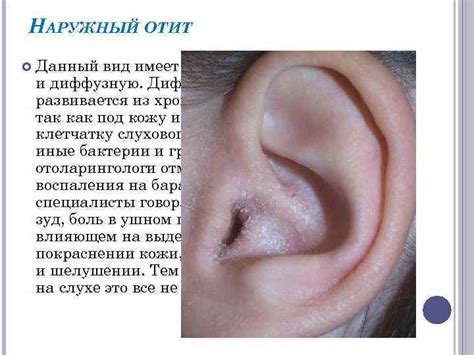 УШНЫЕ БОЛЕЗНИ — это заболевания поражающие орган слуха