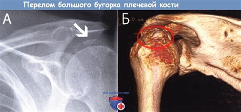 Техника артроскопической операции при переломе бугорка плечевой кости