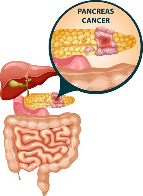 Cough And Pancreatic Cancer at Sonny Rodriguez blog