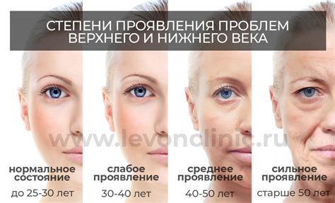 Безоперационная блефаропластика