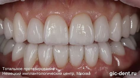 Как получить самые красивые зубы с помощью виниров и коронок - Немецкий ...
