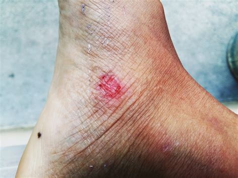 Skin Ulcers and Natural Healing: Homeopathy and Integrative Approaches