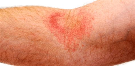 Atopic Dermatitis (Eczema) | Allergy Partners