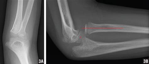FRACTURE OF on emaze