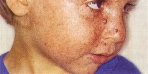 Xeroderma Pigmentosum (XP) Symptoms, Treatment | Houston, Spring Texas
