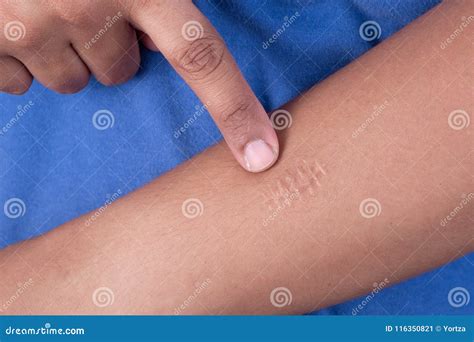 scars  hand stock image image  removal pain