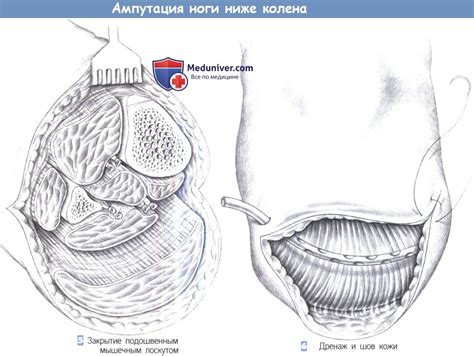 Этапы и техника ампутации ноги ниже колена