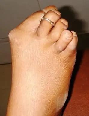 Arthritis of the toe: symptoms and treatment | Diseases and conditions 2024