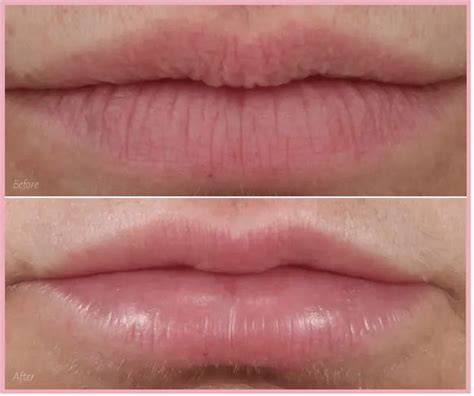 Vertical Lip Lines: Botox or Filler or PRP?