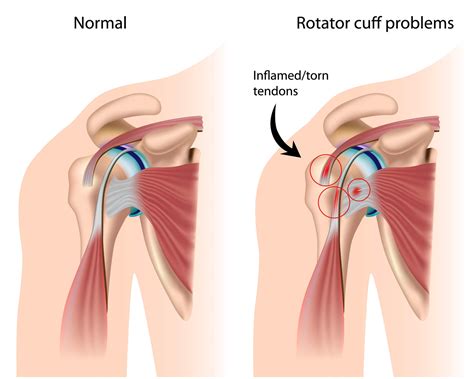Rotator Cuff Injuries in Baseball Players - Loudoun Sports Therapy Center