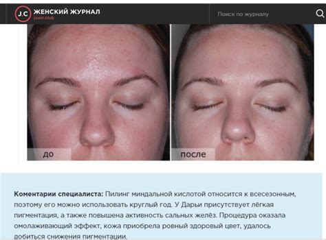Миндальный пилинг в домашних условиях: отзывы, как сделать процедуру ...