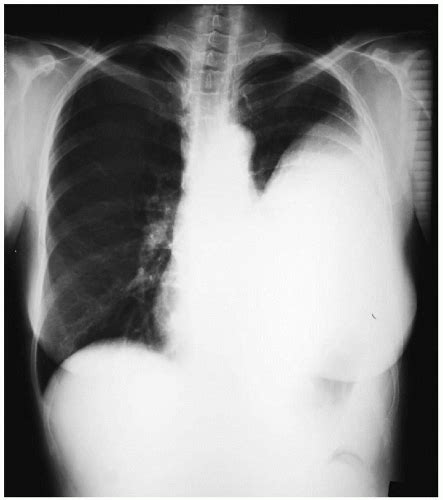 Empyema | Thoracic Key