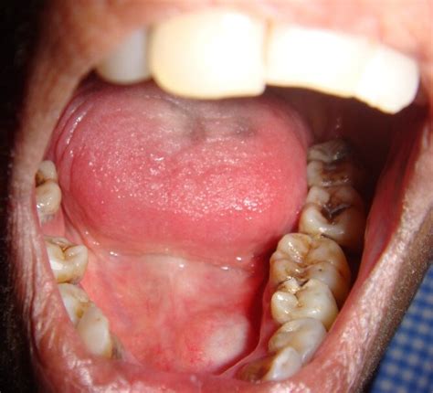 Swelling in left sublingual salivary gland region | Download Scientific ...