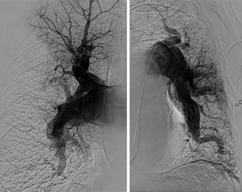 operable cteph   pte   option thoracic key
