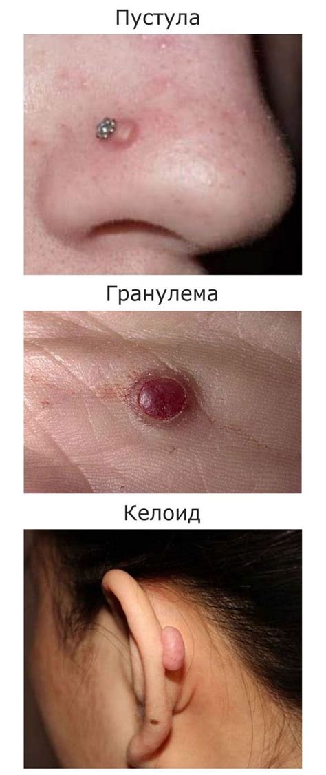 Воспаление, шишка после пирсинга на крыле носа — лечение