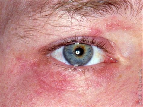 Perioral-Dermatitis - Evidence-Based Treatments To Help You Heal ...