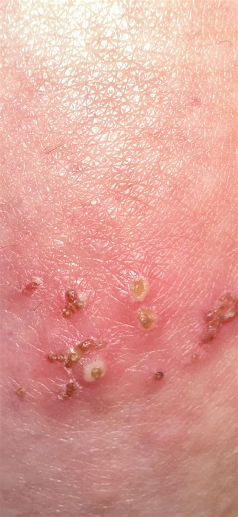 Pending hsv test, this is on the butt cheek. Does this resemble herpes