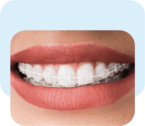 Orthodontic Brackets - Dra. Dubraska Mouawad