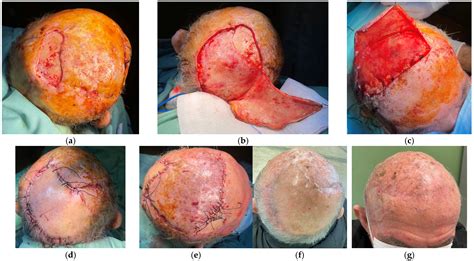 Reconstruction of Scalp Defects with Rotational Flaps: Where Is the Limit?