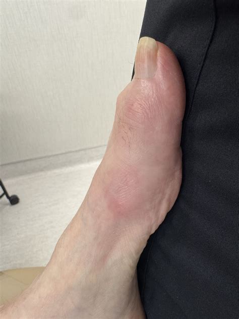 Hallux Rigidus Before and After Photos | Northwest Surgery Center