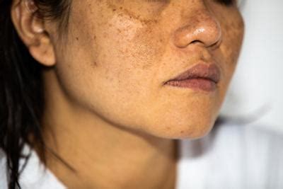 Causes of Skin Discoloration
