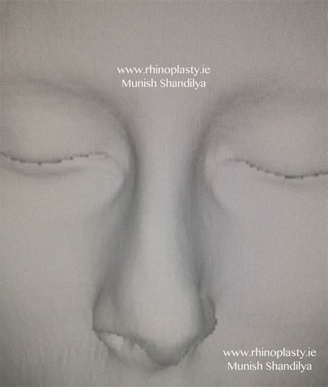 Rhinoplasty Dublin, Ireland - Nose Job Surgery, ENT Surgeon