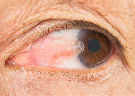 pterygium surfers eye  symptoms treatment