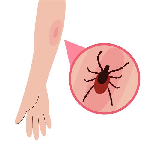 The human hand with the tick bite. Tick bite hand.Tick bite. Healthcare