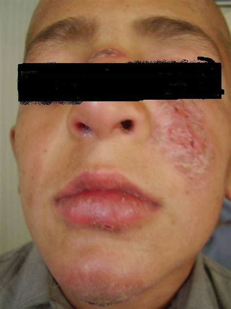 Leishmaniasis Causes Symptoms And Treatment Netmeds - vrogue.co