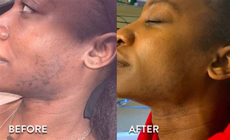Laser Hair Removal Before and After Pictures | Atlanta, GA