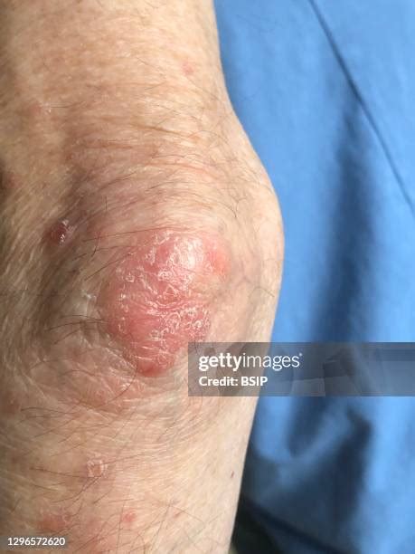 Psoriasis Elbows Photos and Premium High Res Pictures - Getty Images