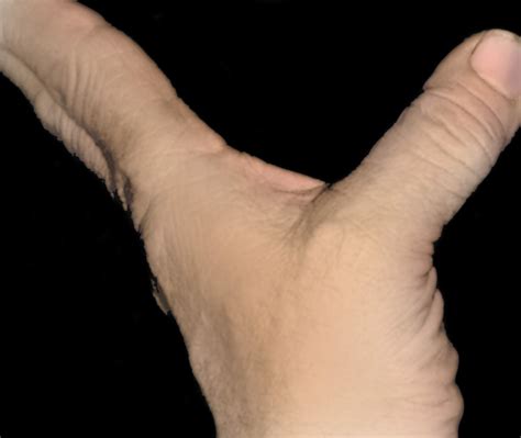 Dislocated Thumb Symptoms