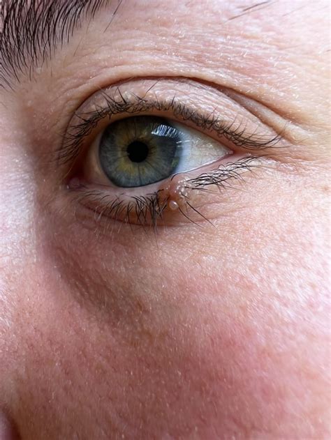 Mole Removal - Lower Eyelid : r/PlasticSurgery