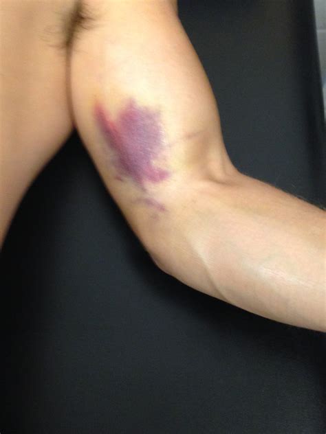 Crutches Bruising Armpits at Olivia Brewster blog